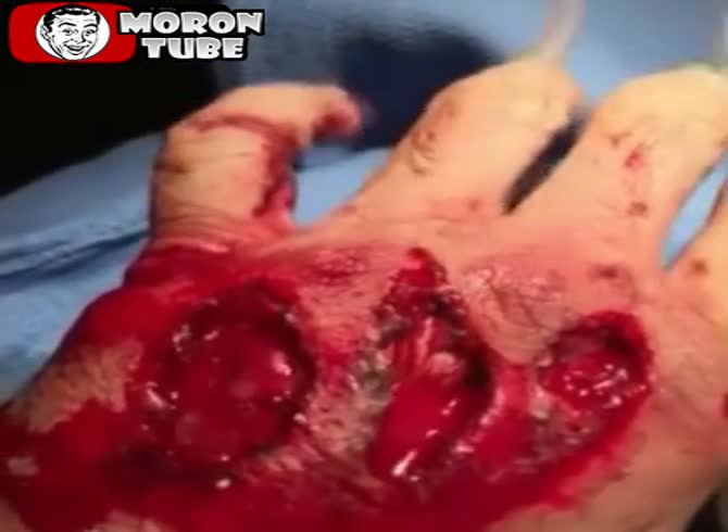 Video :A motorbike accident left a hand hurt (public alerted)